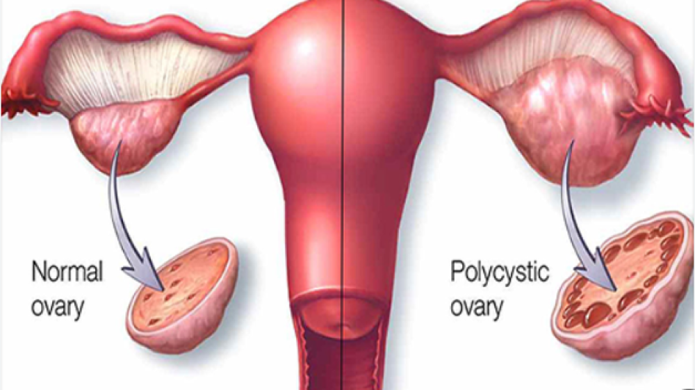 تشخیص بیماری تخمدان پلی کیستیک با آزمایش خون